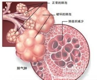 如何做效輔助治療慢阻肺?