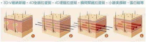 3D蛋白線 什麼是3D蛋白埋線