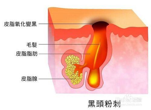 如何安全有效的去除黑頭