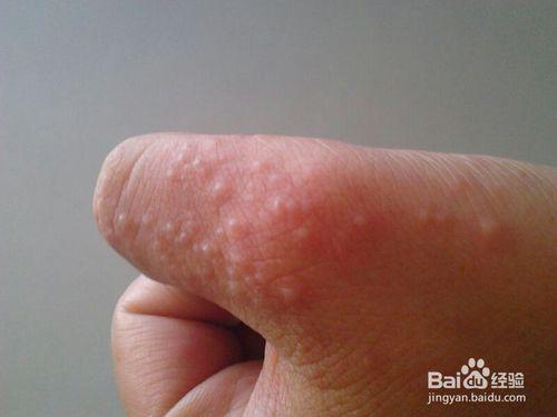 夏天汗皰疹（小水泡、瘙癢、脫皮）最佳治療方法