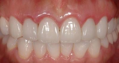 矯正牙齒時磨牙(片切)的優缺點，磨牙還是拔牙？