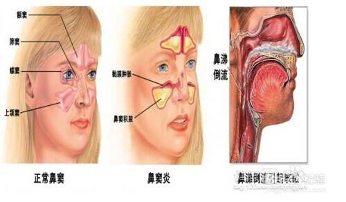 如何預防鼻炎呢