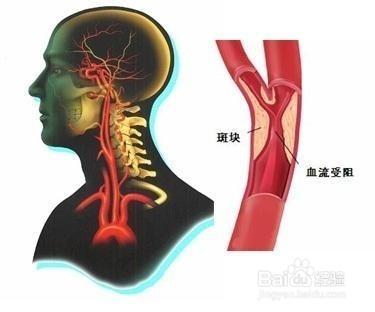 頸椎病最容易被忽略的症狀？