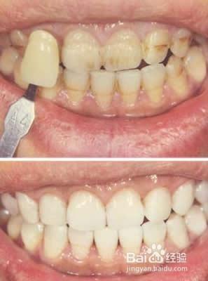 美白牙齒的食療方法