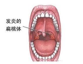 急慢性支氣管炎、慢性咽炎和扁桃體炎症狀與用藥