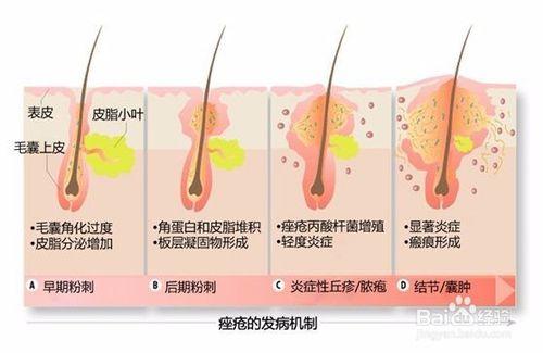 怎樣巧治痘痘