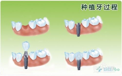 種植牙的過程以及需要注意的事項