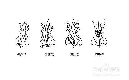 鼻中隔偏曲/彎曲諮詢常見問題回答