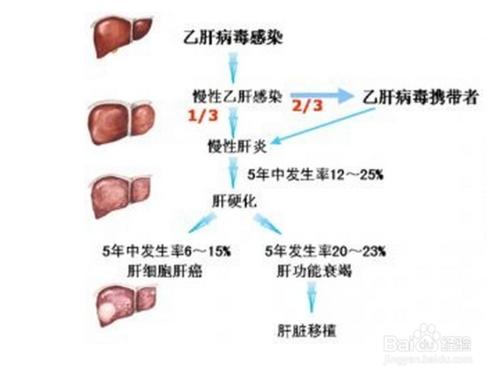 乙肝大三陽能轉陰嗎？中草藥治癒乙肝大三陽