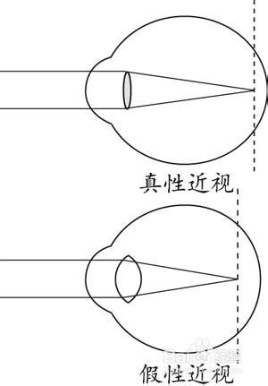 如何分辨真性近視和假性近視？