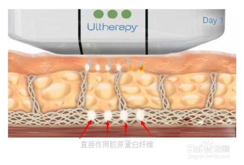 什麼是埋線提升