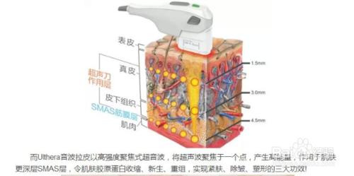 什麼是埋線提升