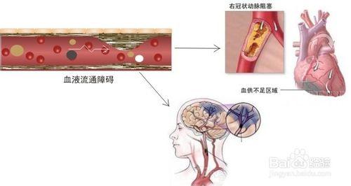 怎樣防止心腦血管疾病