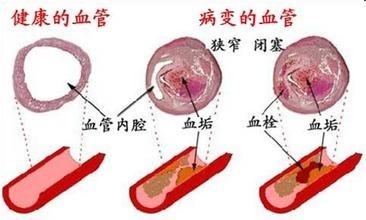 通血管的古方，不管多嚴重都能通