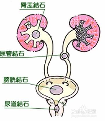 如何認識“腎結石”