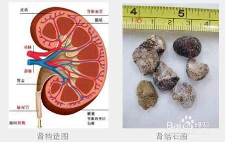 腎結石的早期症狀