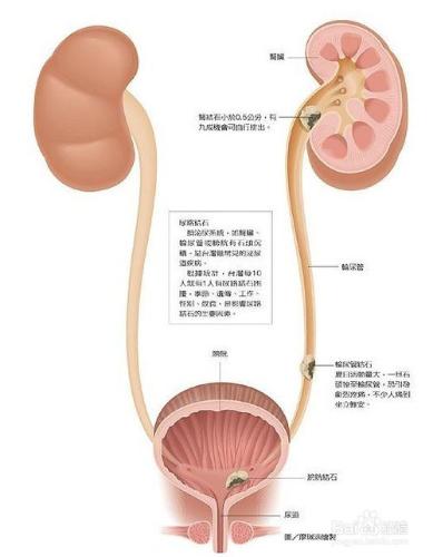 腎結石的早期症狀