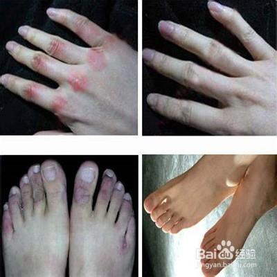 手腳長凍瘡怎麼辦 以及治療的偏方