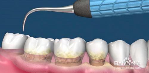 牙齦出血的原因和解決辦法？