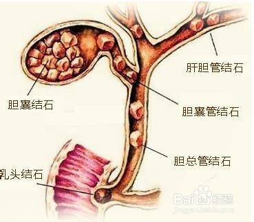 膽石病該怎樣治療呢？