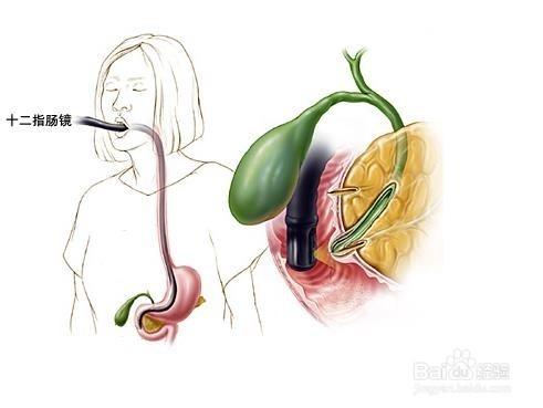 膽石病該怎樣治療呢？