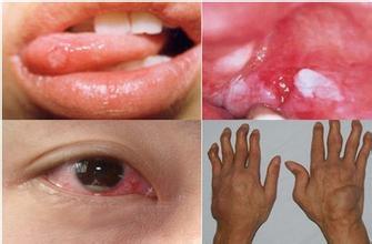 口腔潰瘍 反覆口腔潰瘍會造成眼睛失明