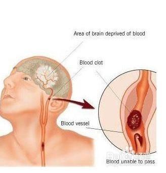 腦血栓有什麼前兆