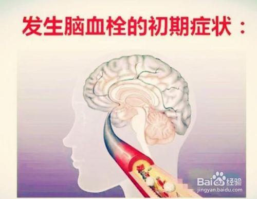 健康小常識：發生腦血栓的前兆