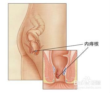 預付痔瘡的方法