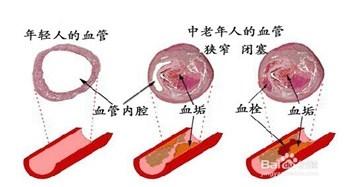 治療腦血栓最好的藥