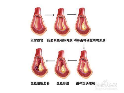 治療腦血栓最好的藥