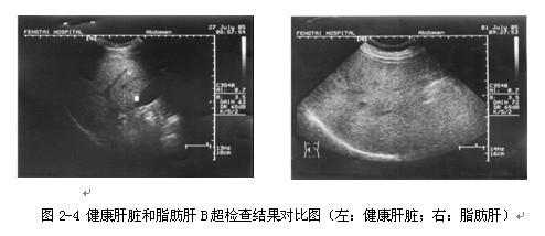 得了脂肪肝如何治療？