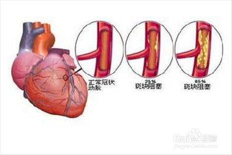 得了脂肪肝如何治療？