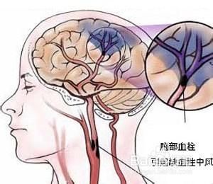 腦血栓的治療方法