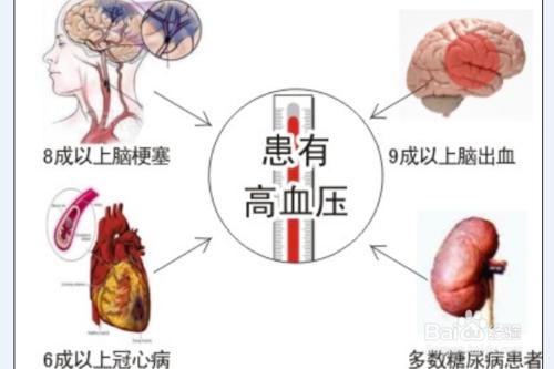 高血壓的症狀及治療方法