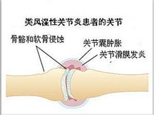 如何阻止類風溼關節炎的發生