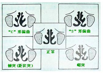 鼻中隔偏曲手術怎樣治療？