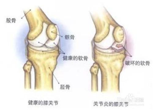 什麼是類風溼性關節炎