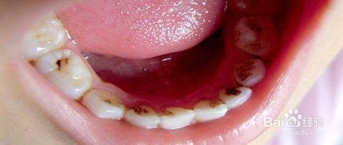 小孩蛀牙的成因及預防