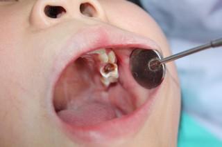 小孩蛀牙的成因及預防