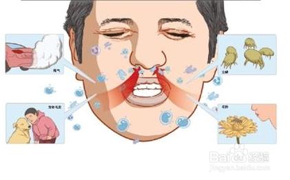 過敏性鼻炎怎麼治 過敏性鼻炎治療方法分享