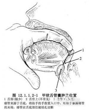 糖尿病人褥瘡的治療方法