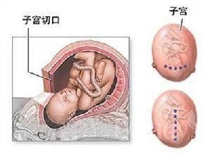 孕中期引產會導致哪些產後併發症