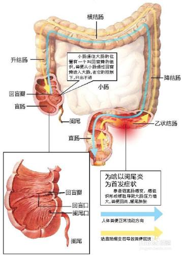 如何識別闌尾炎