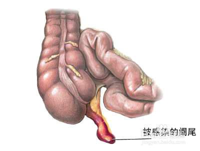 如何識別闌尾炎