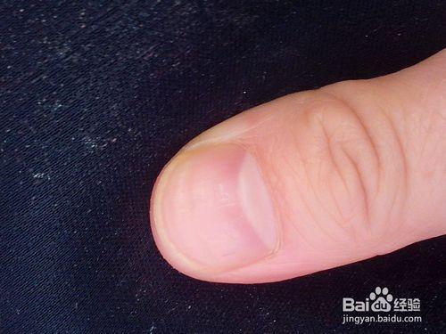 你的指甲出問題了嗎？