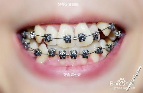 牙齒矯正：[5]帶牙套的第七天，基本適應