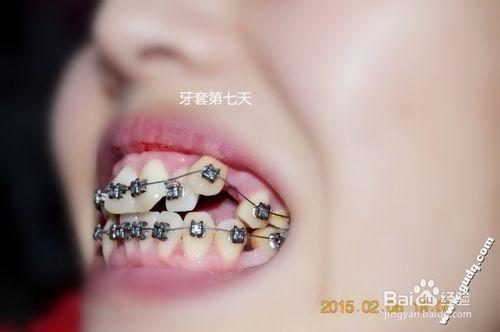 牙齒矯正：[5]帶牙套的第七天，基本適應