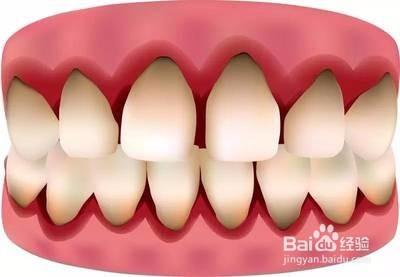 牙齦經常出血怎麼辦