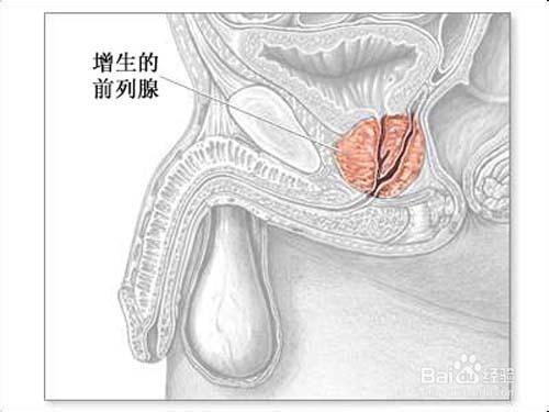 前列腺增生要注意什麼呢